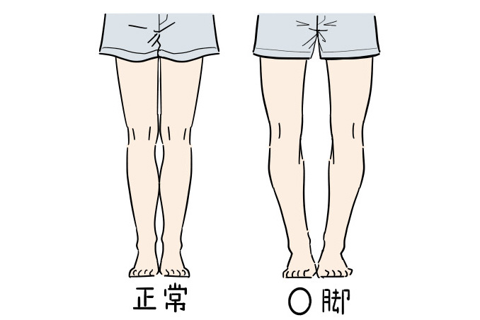 O脚のイメージ