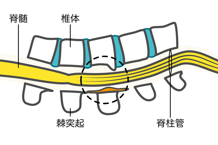 脊柱管狭窄症のイメージ