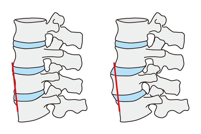 腰椎分離症・すべり症のイメージ